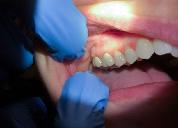 Best Emergency Treatment for Oral Infections in White Oak, MS